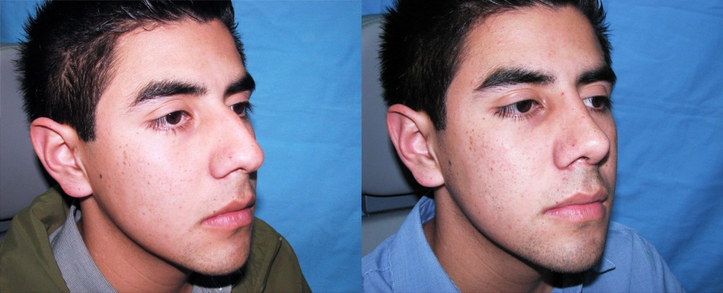 Paciente 1 de rinoplastía