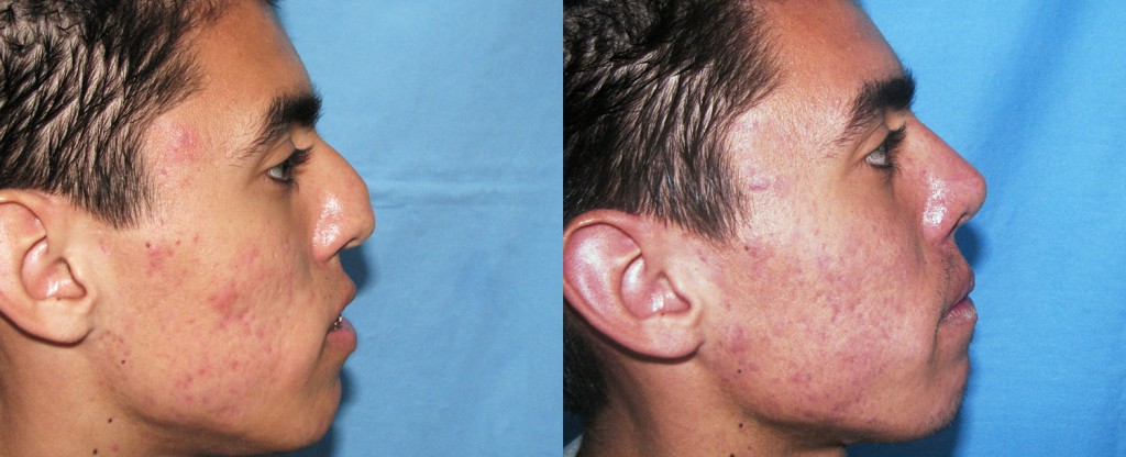 Paciente 10 de rinoplastía