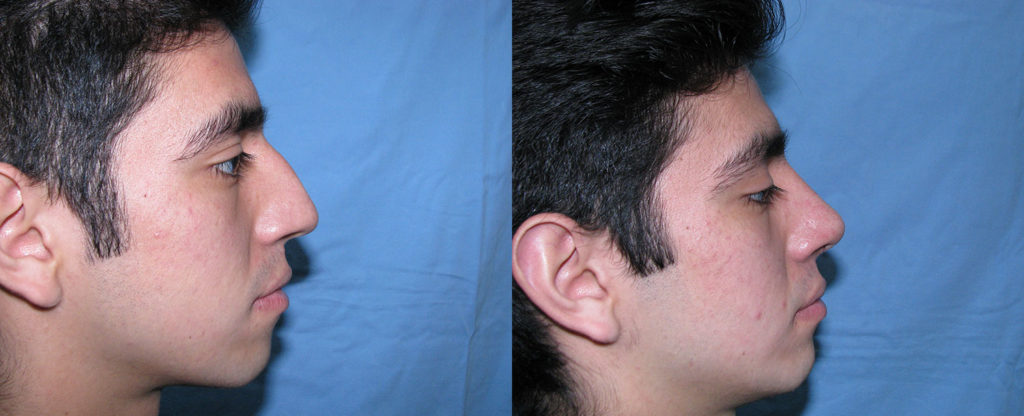 Paciente 11 de rinoplastía