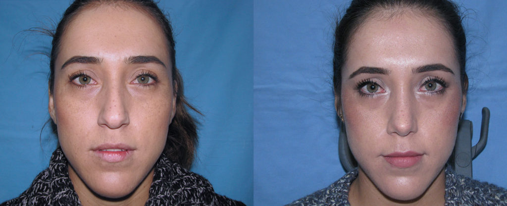 Paciente 12 de rinoplastía