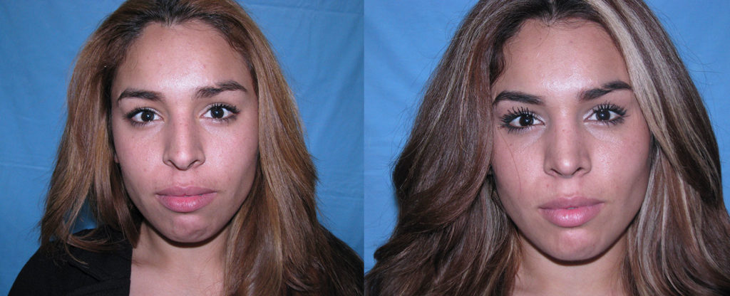 Paciente 13 de rinoplastía