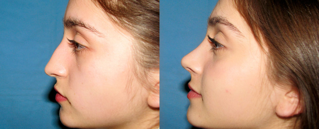 Paciente 14 de rinoplastía