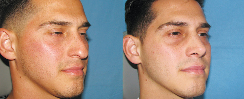 Paciente 15 de rinoplastía