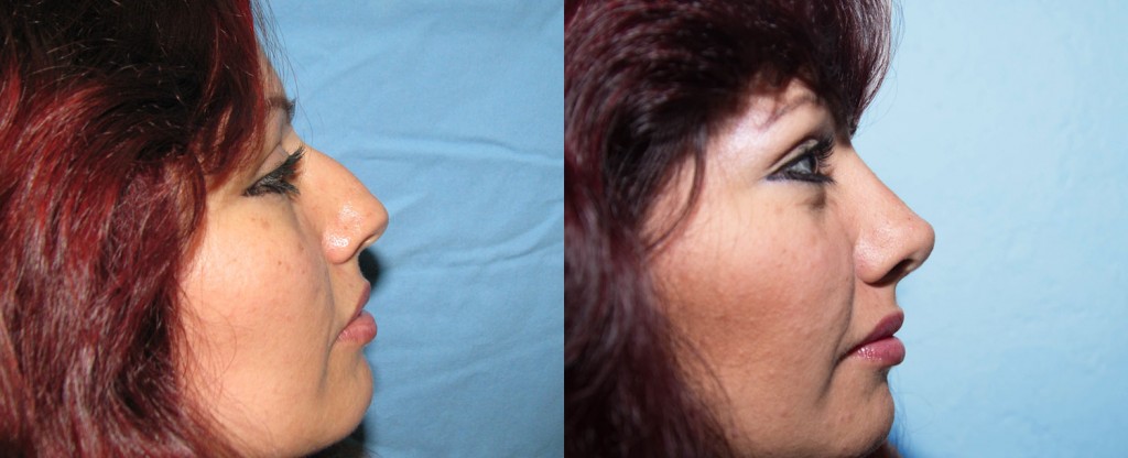 Paciente 2 de rinoplastía