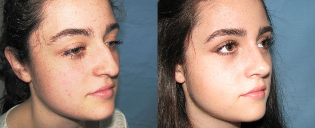 Paciente 3 de rinoplastía