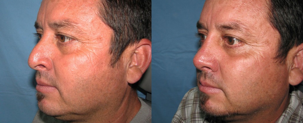 Paciente 4 de rinoplastía