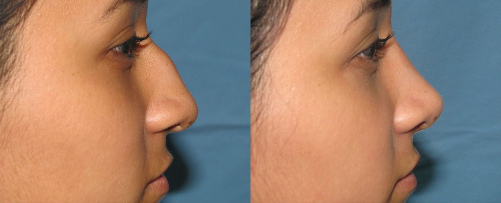 Paciente 5 de rinoplastía