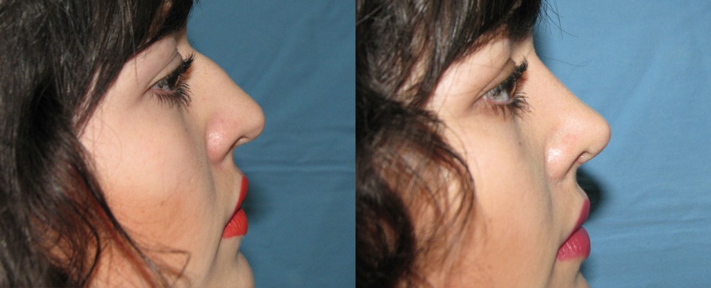 Paciente 6 de rinoplastía