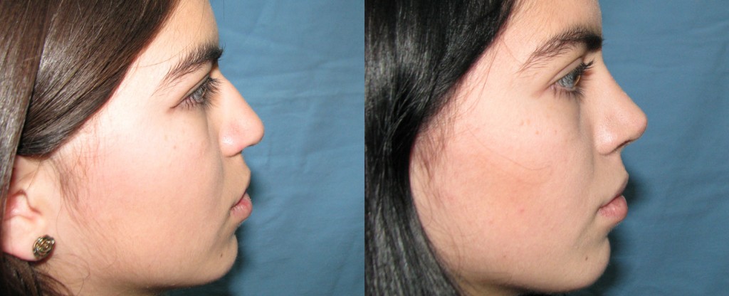 Paciente 7 de rinoplastía