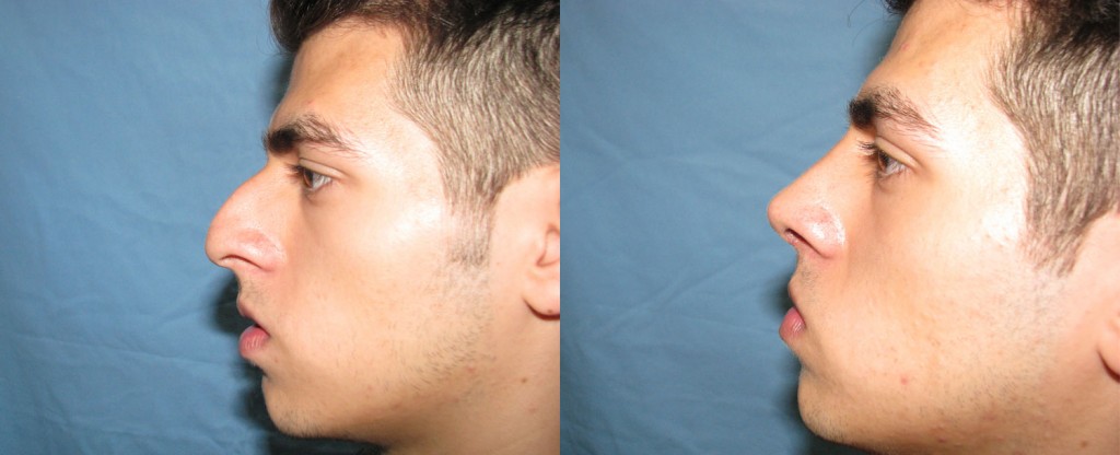 Paciente 8 de rinoplastía