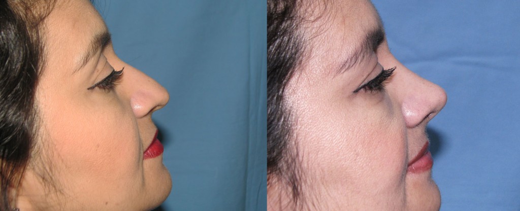Paciente 9 de rinoplastía